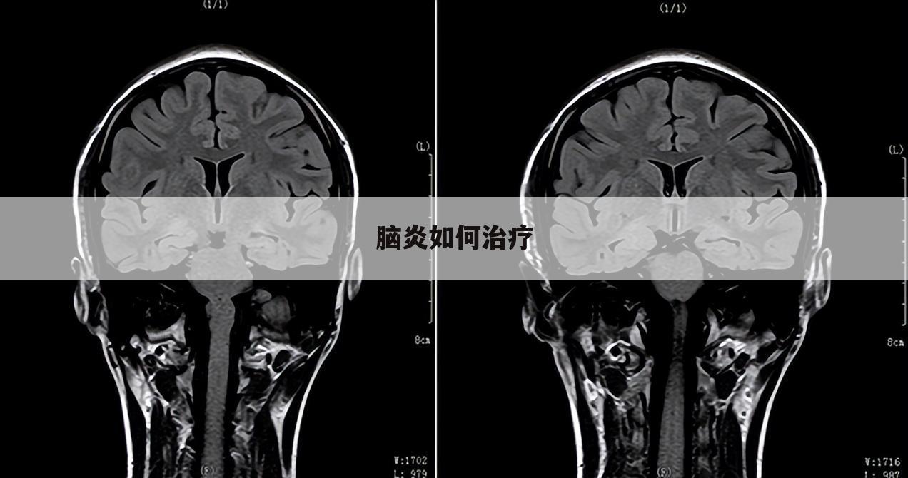 脑炎如何治疗