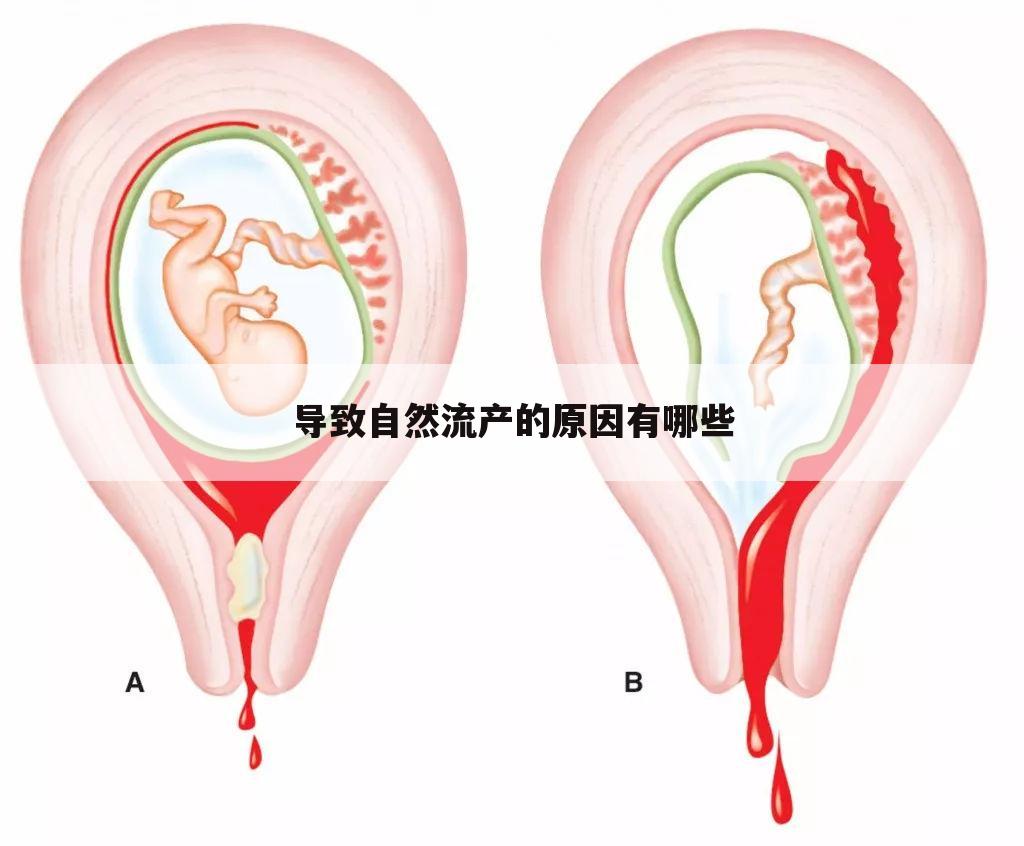 导致自然流产的原因有哪些